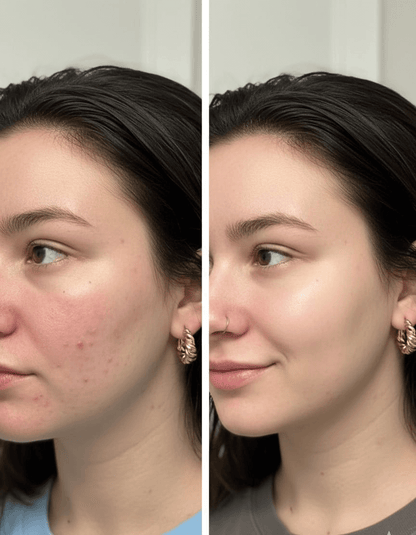 The Ordinay Niacinamida 10% + Zinc 1%